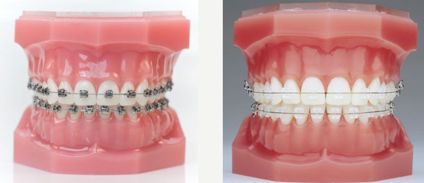 Orthodontie adulte & enfant prix - Guide Traitement dentaire - Dentego