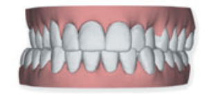 L'histoire des gouttières invisibles en orthodontie - Cabinet d
