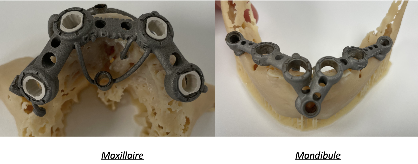Kangwell 15PCS bloc de morsure dentaire de la bouche | Nouveau type,  Dentaire Antérieur Postérieur, Dispositif D'Ouverture Des Dents, Support