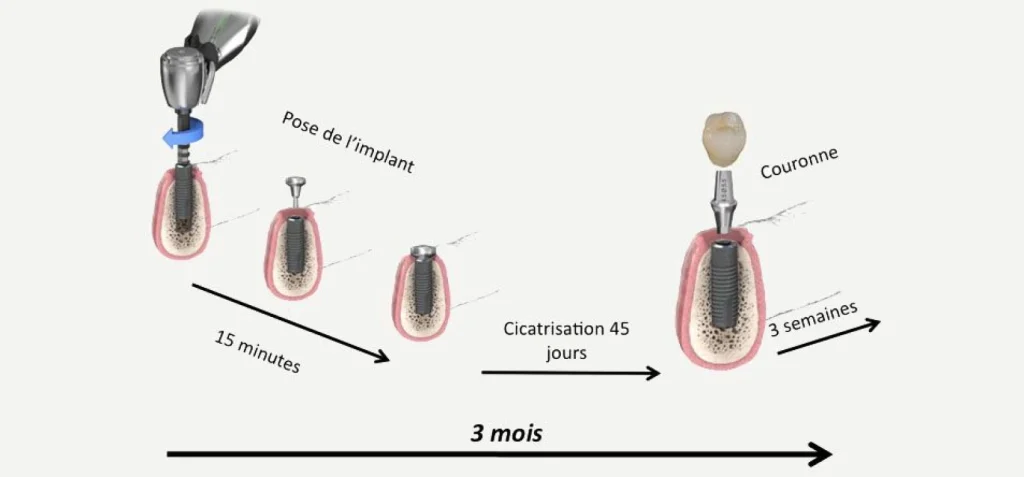 Implants dentaires