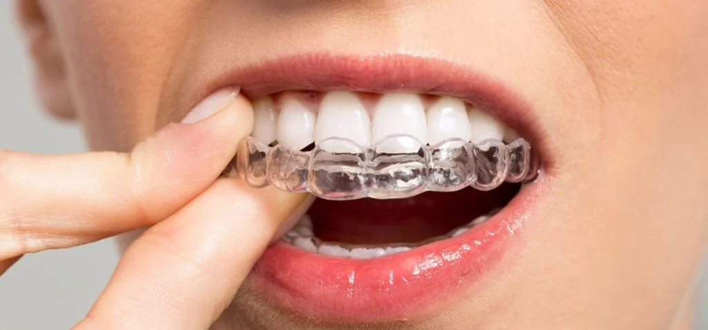 Les gouttières transparentes : orthodontistes à Rodez, Drs Pascual