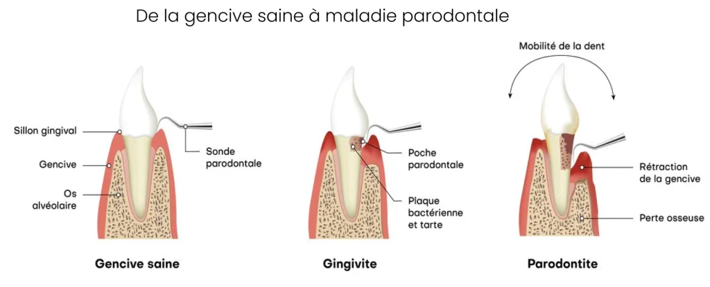 Bilan parodontal