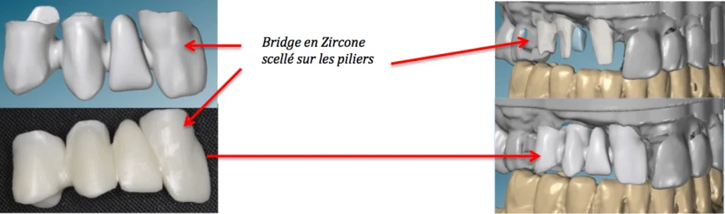 Prothèse sur implant