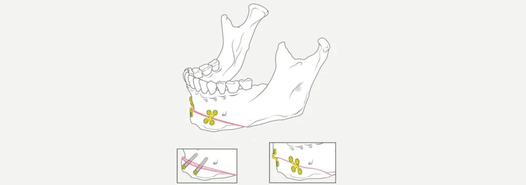 Chirurgie orthognatique