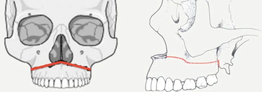 Chirurgie orthognatique