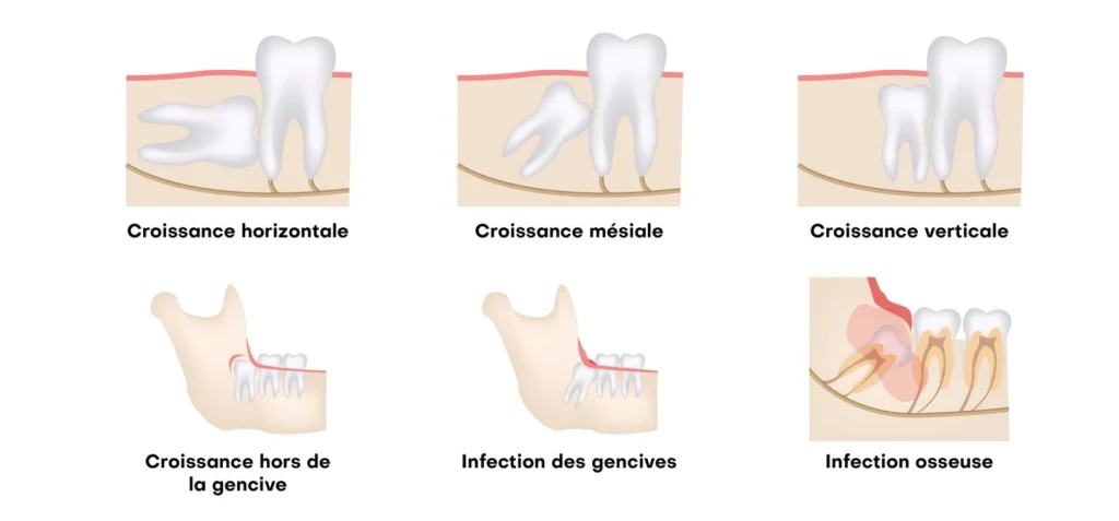 Dents de sagesse