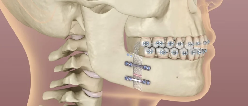 Chirurgie orthognatique