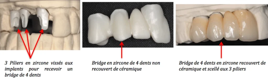 Prothèse sur implant