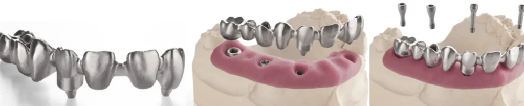 Prothèse sur implant