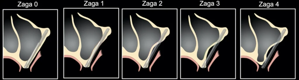 Implants Zygomatiques