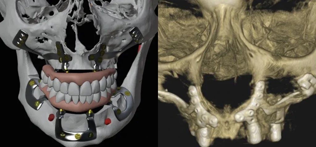 Implants Sous Périostés