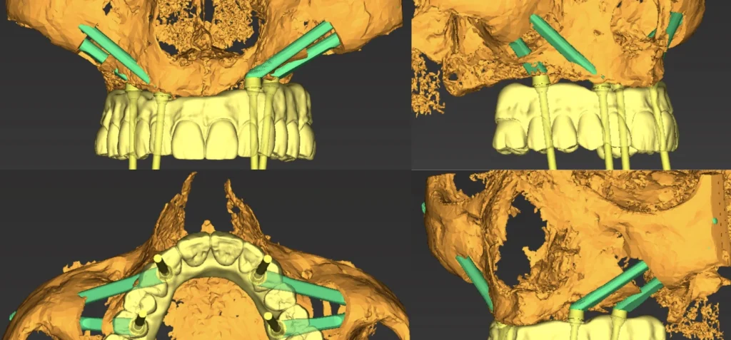 Implants Zygomatiques