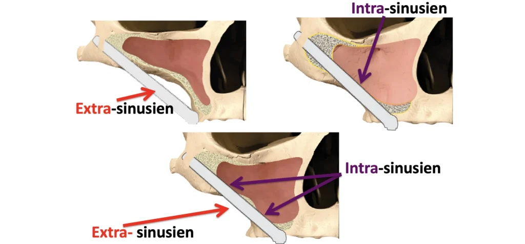 Implants Zygomatiques