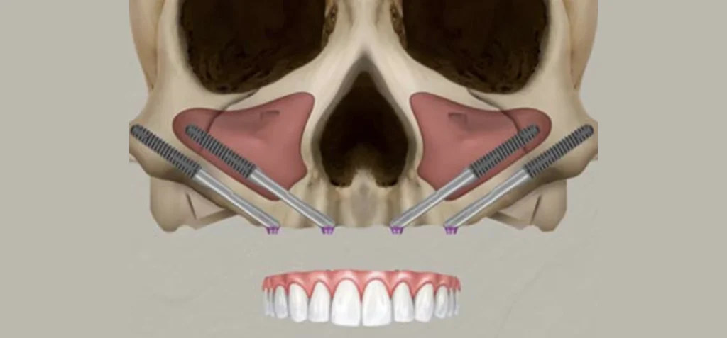 Implants Zygomatiques