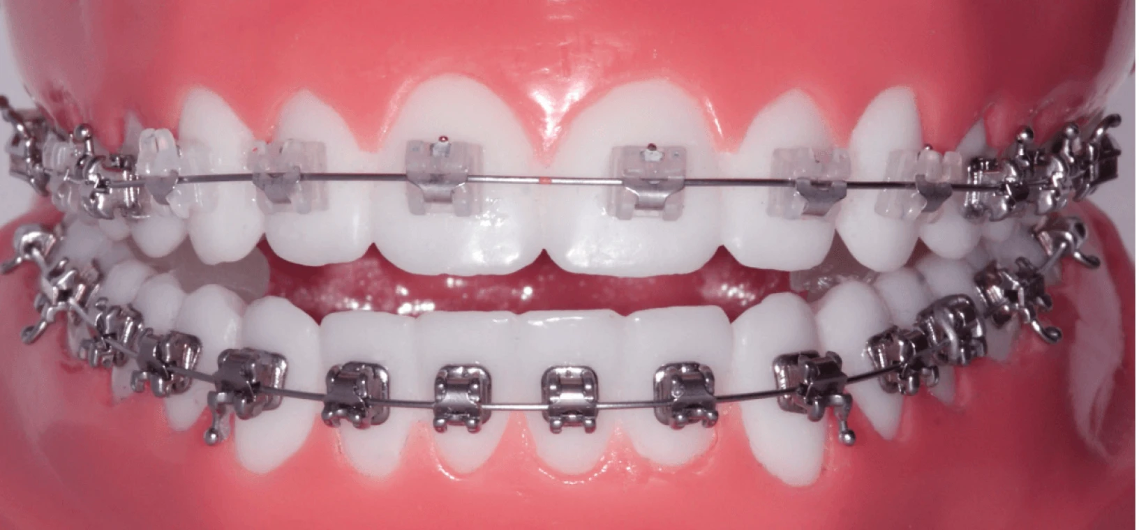 Démonstration de traitement d’orthodontie avec multi-bagues par le Dr Pascual