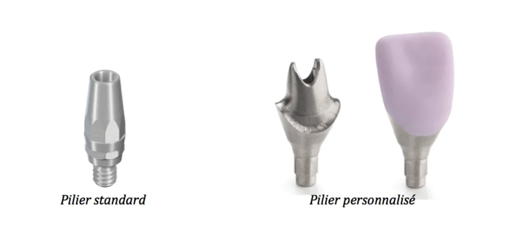 Prothèse sur implant