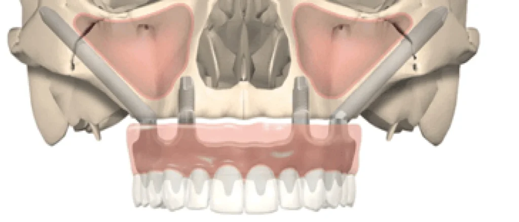 Implants Zygomatiques