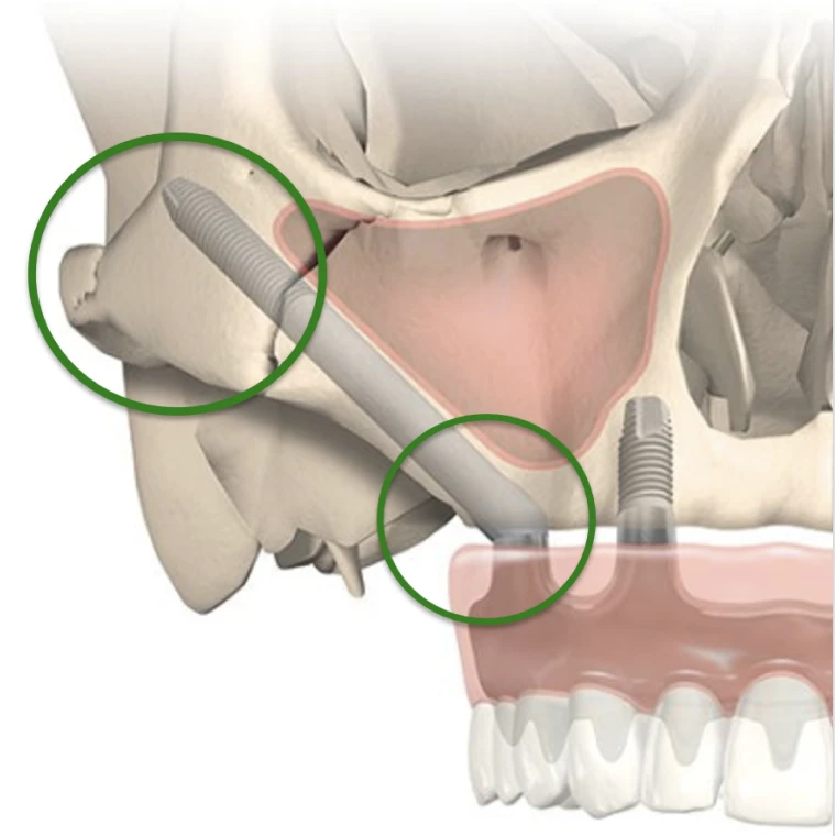 Implants Zygomatiques