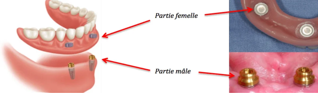 Prothèse sur implant