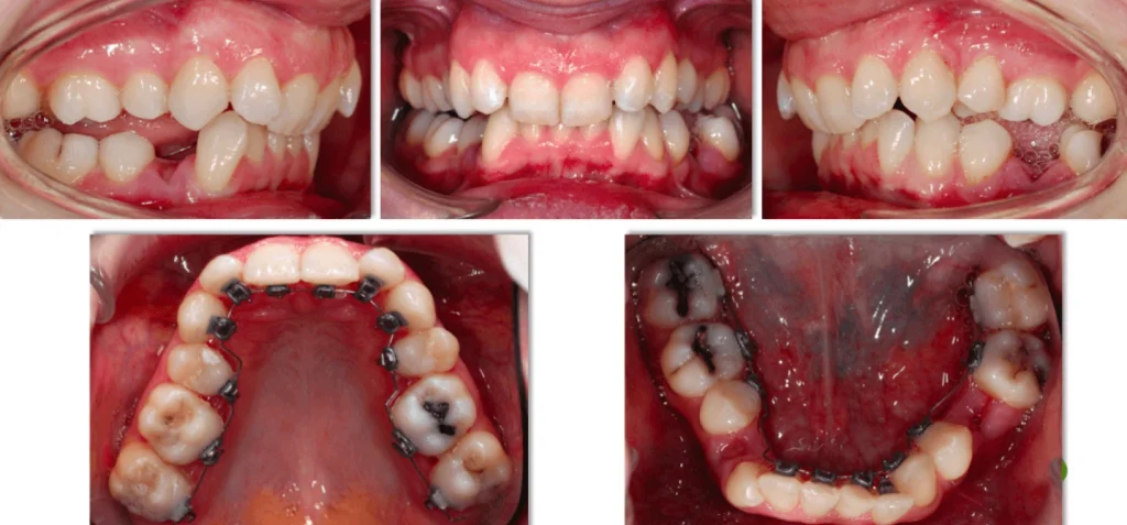 Orthodontistes à Rodez : Traitement en technique linguale par Dr Pascual