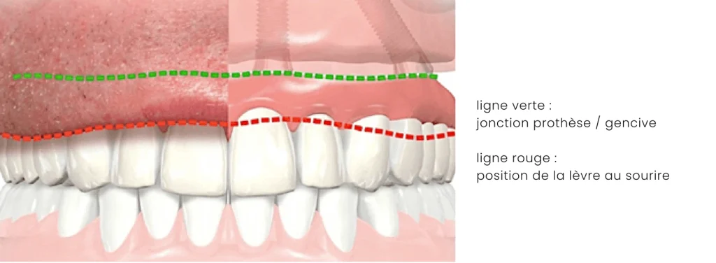 Fausse gencive au Centre d’orthodontie et d’implantologie Ruthénois